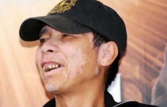 冯小刚得白癜风的原因，一般活多久？
