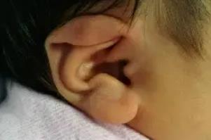 <a href=/e/tags/?tagname=新生儿 target=_blank class=infotextkey>新生儿</a>耳朵粘连需要矫正吗