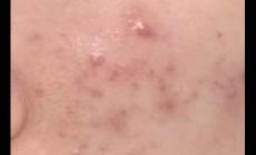 痘痘变成硬硬的鼓包怎么去除 痘痘变成硬硬的鼓包图片