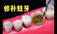 “10岁娃用牙洞修复牙膏后损失6颗牙”火的原因医生说出了真相