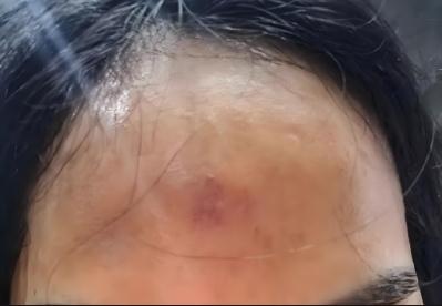 印堂发红是什么的征兆 印堂发红预示着出现哪些健康问题