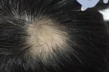 头发秃了一块是什么原因造成的