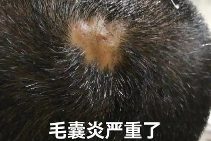 头皮毛囊炎挂哪个科室的号 头皮毛囊炎挂什么科室的号好