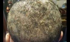 头皮癣跟头皮屑有区别吗 头皮屑和头皮癣的区别是什么